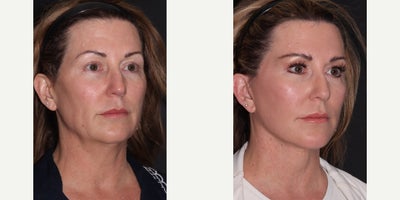 Eyelid Surgery before and after photo