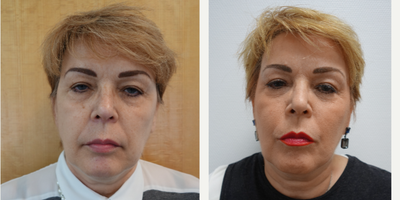 Facelift before and after photo
