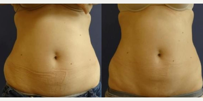 i-Lipo before and after photo