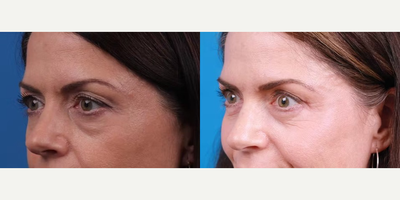 Laser Resurfacing before and after photo