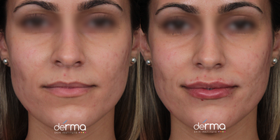Radiesse before and after photo
