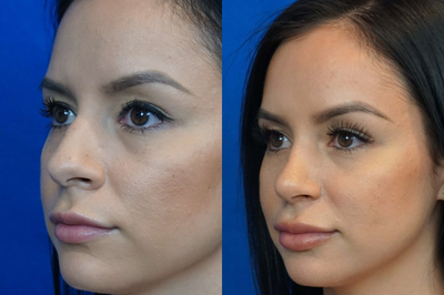 Septoplasty before and after photo