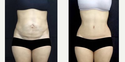 Tummy Tuck before and after photo