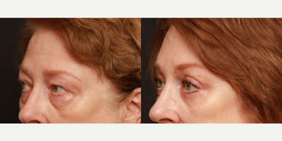 Brow Lift before and after photo