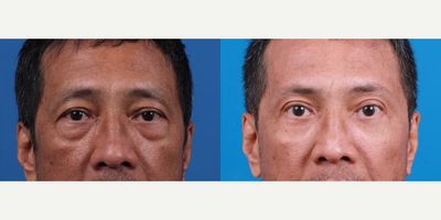 Brow Lift before and after photo