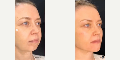 Chin Filler before and after photo