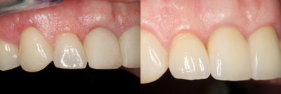 Dental Crown before and after photo
