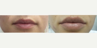 Lip Fillers before and after photo