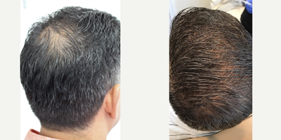 PRP for Hair Loss before and after photo