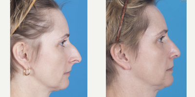 Rhinoplasty before and after photo
