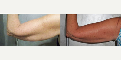 Smart Lipo before and after photo