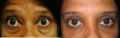 Eyelid Surgery before and after photo