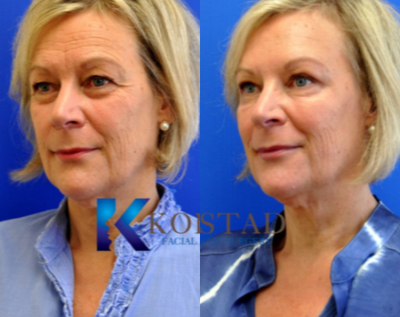 Eyelid Surgery before and after photo