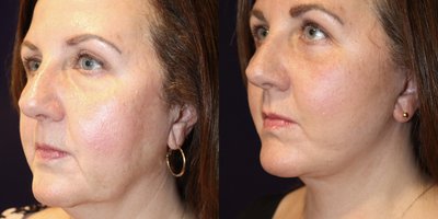 Eyelid Surgery before and after photo