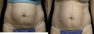 Laser Liposuction before and after photo