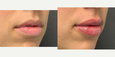 Lip Fillers before and after photo