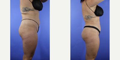 Lipo 360 BBL before and after photo