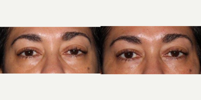 Restylane before and after photo