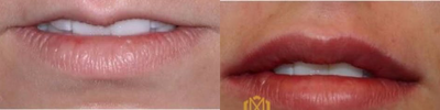 Dermal Fillers before and after photo