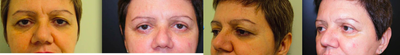 Eyelid Surgery before and after photo