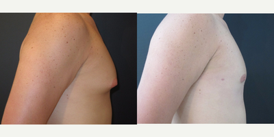 Gynecomastia Surgery before and after photo