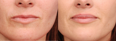 Lip Fillers before and after photo