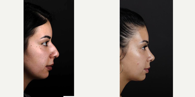 Rhinoplasty before and after photo