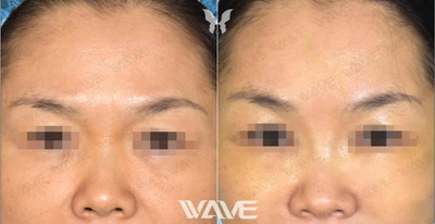 Brow Lift before and after photo