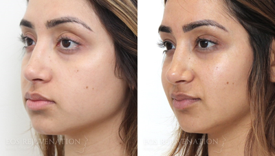 Cheek Augmentation before and after photo