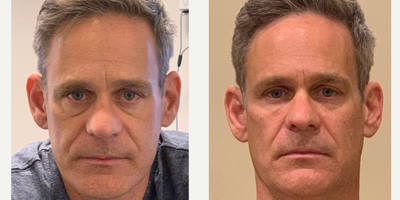 Dermal Fillers before and after photo