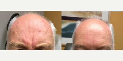 Dysport before and after photo