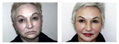 Facelift before and after photo