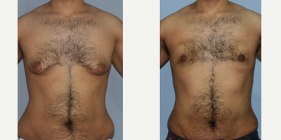 Gynecomastia Surgery before and after photo