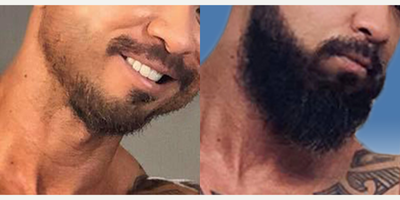 Beard Transplant before and after photo