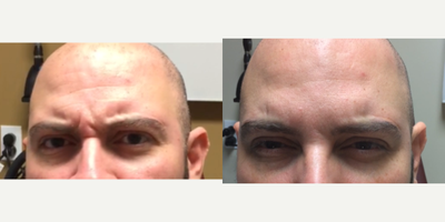 Botox before and after photo