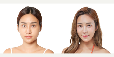 Eyelid Surgery before and after photo