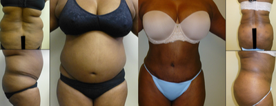 Brazilian Butt Lift before and after photo