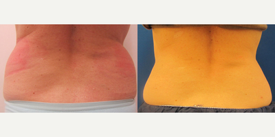 CoolSculpting before and after photo