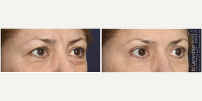 Eyelid Surgery before and after photo