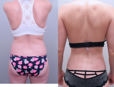 Vaser Liposuction before and after photo