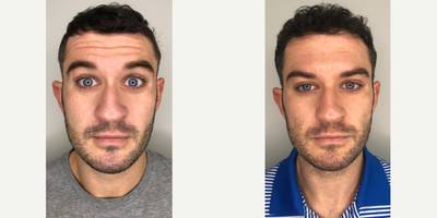 Botox before and after photo
