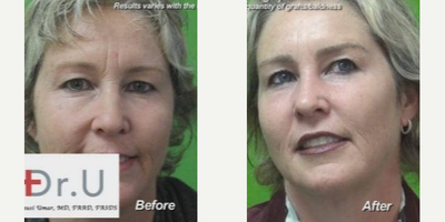 Eyebrow Transplant before and after photo