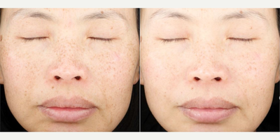Microneedling before and after photo