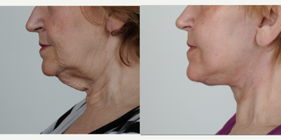 Neck Lift before and after photo