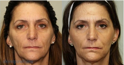 Sculptra before and after photo