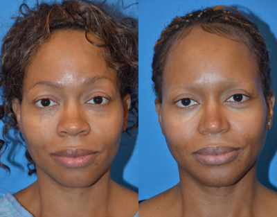 African American Rhinoplasty before and after photo