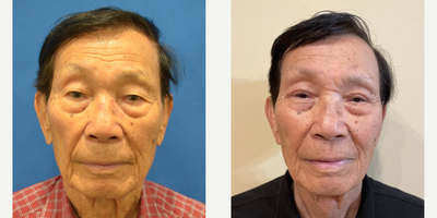 Eyelid Surgery before and after photo