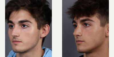 Rhinoplasty before and after photo