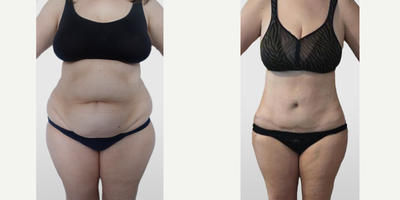 Tummy Tuck before and after photo