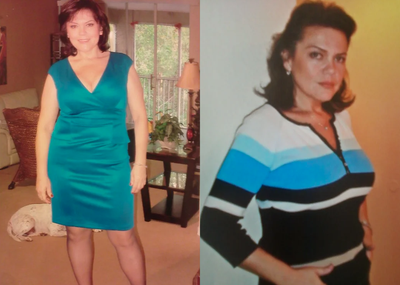 Gastric Bypass before and after photo